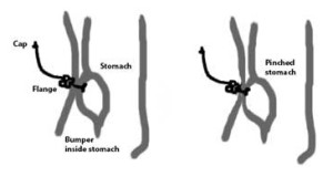 feeding tube line drawing